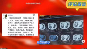 案例展示9 38岁肺癌晚期超预期存活